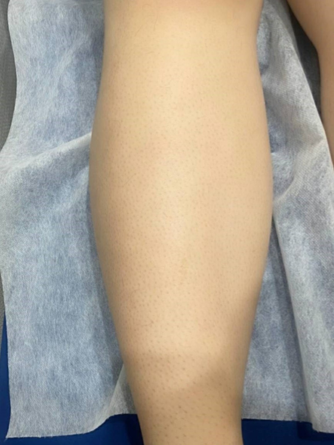 หลังทำเลเซอร์กำจัดขน Long Pulse Nd:YAG บริเวณขา