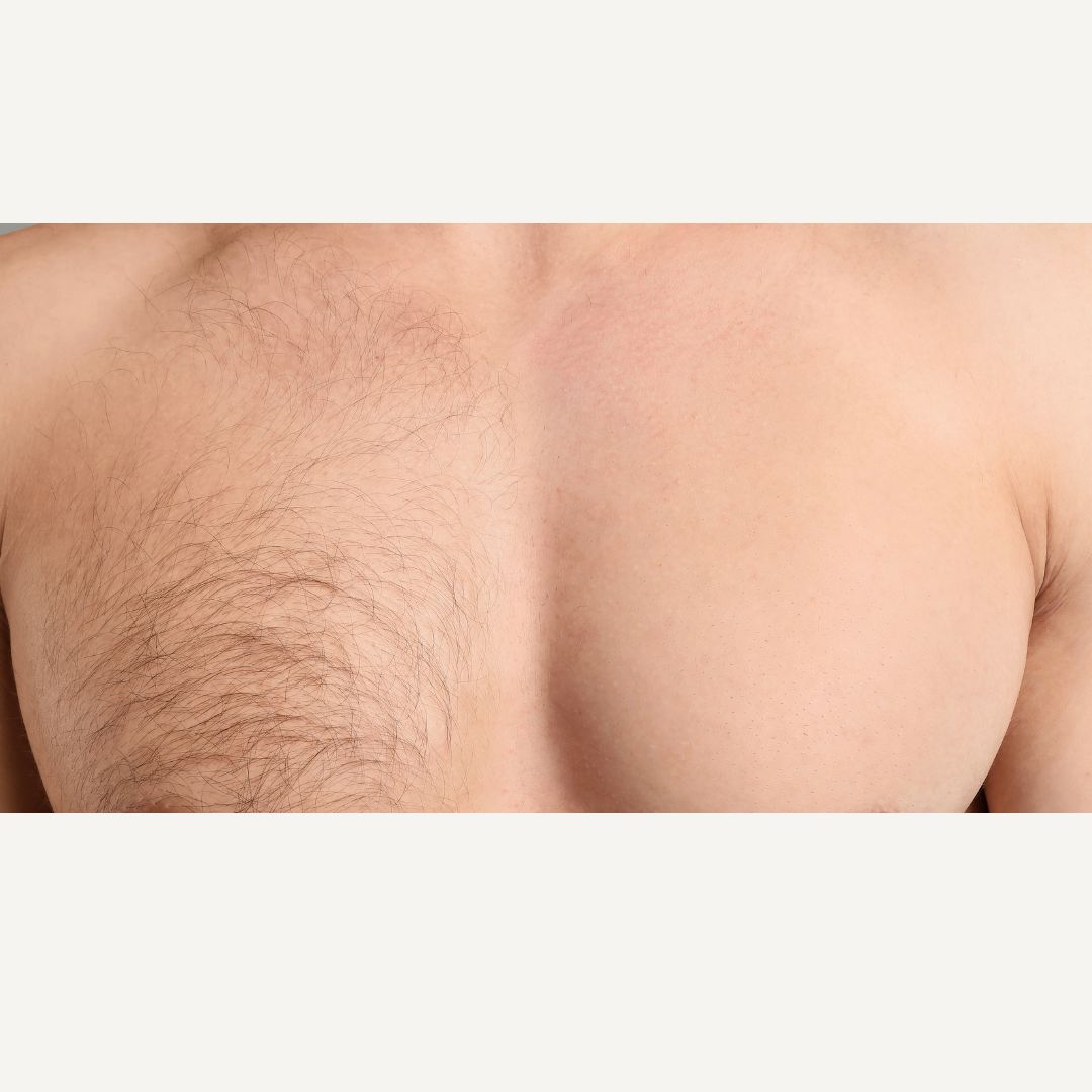 Laser hair removal at BAC Bangkok Aesthetic Clinic