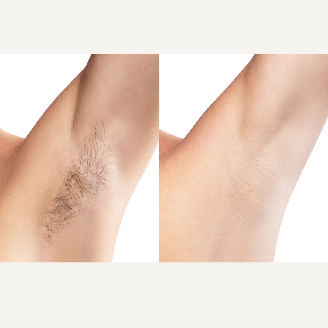 Hair removal treatment at BAC Bangkok Aesthetic Clinic Bangkok