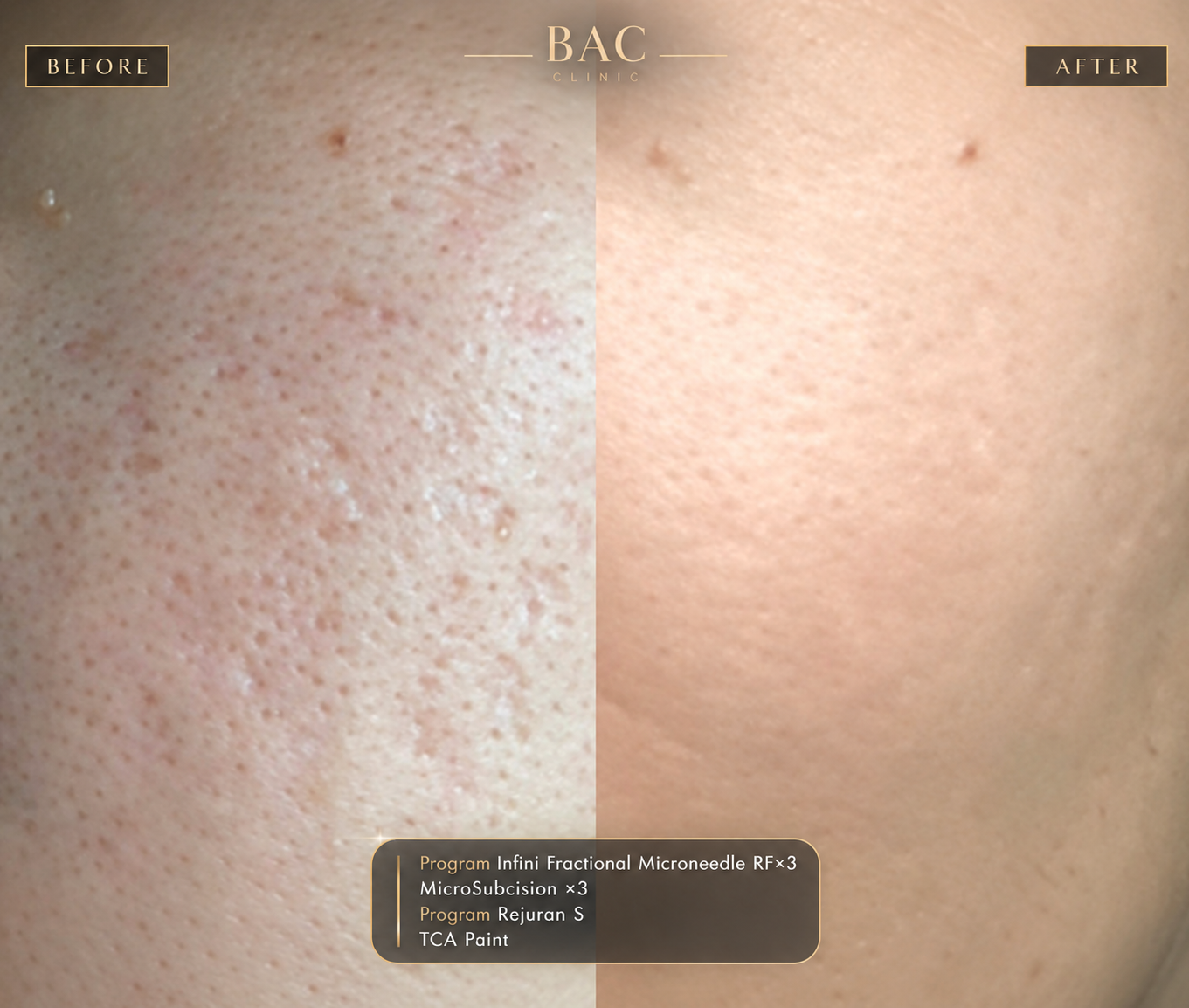 Acne scar treatment before and after at BAC Bangkok Aesthetic Clinic