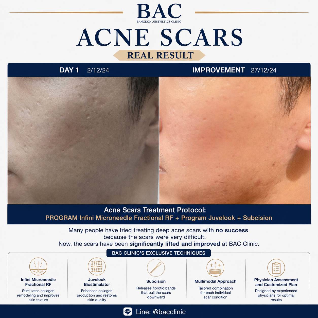 Combination acne scar treatment result BAC Clinic