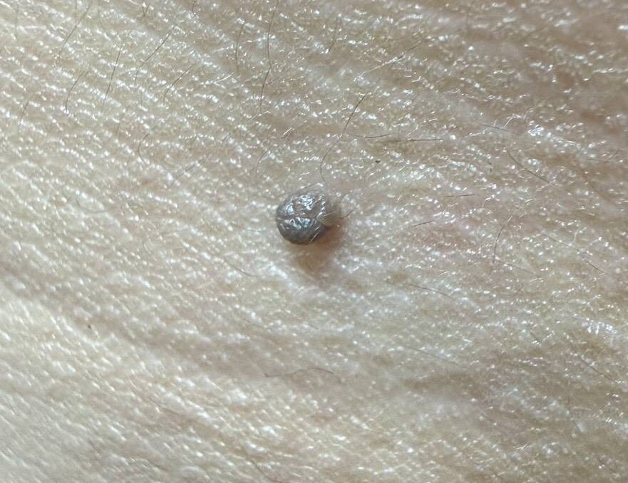 Raised benign seborrheic keratosis before UltraPulse CO2 laser treatment at BAC Clinic