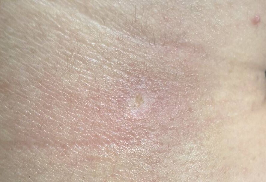 Immediately after UltraPulse CO2 laser removal of benign skin lesion at BAC Clinic Bangkok