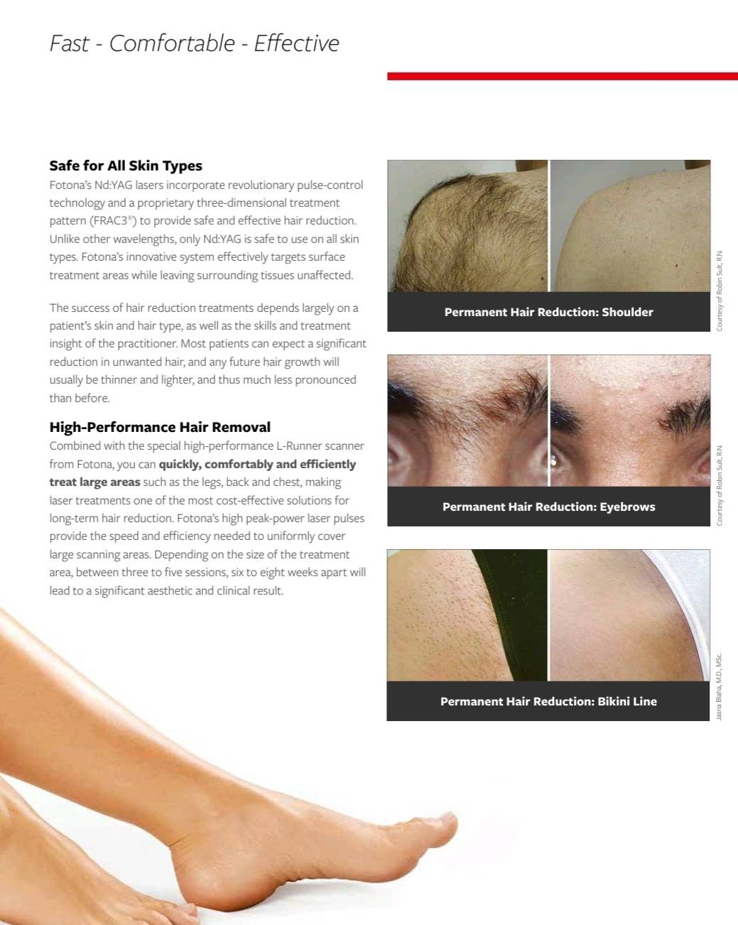 Fotona XP Long Pulse Nd YAG men's laser hair removal BAC Bangkok Aesthetic Clinic