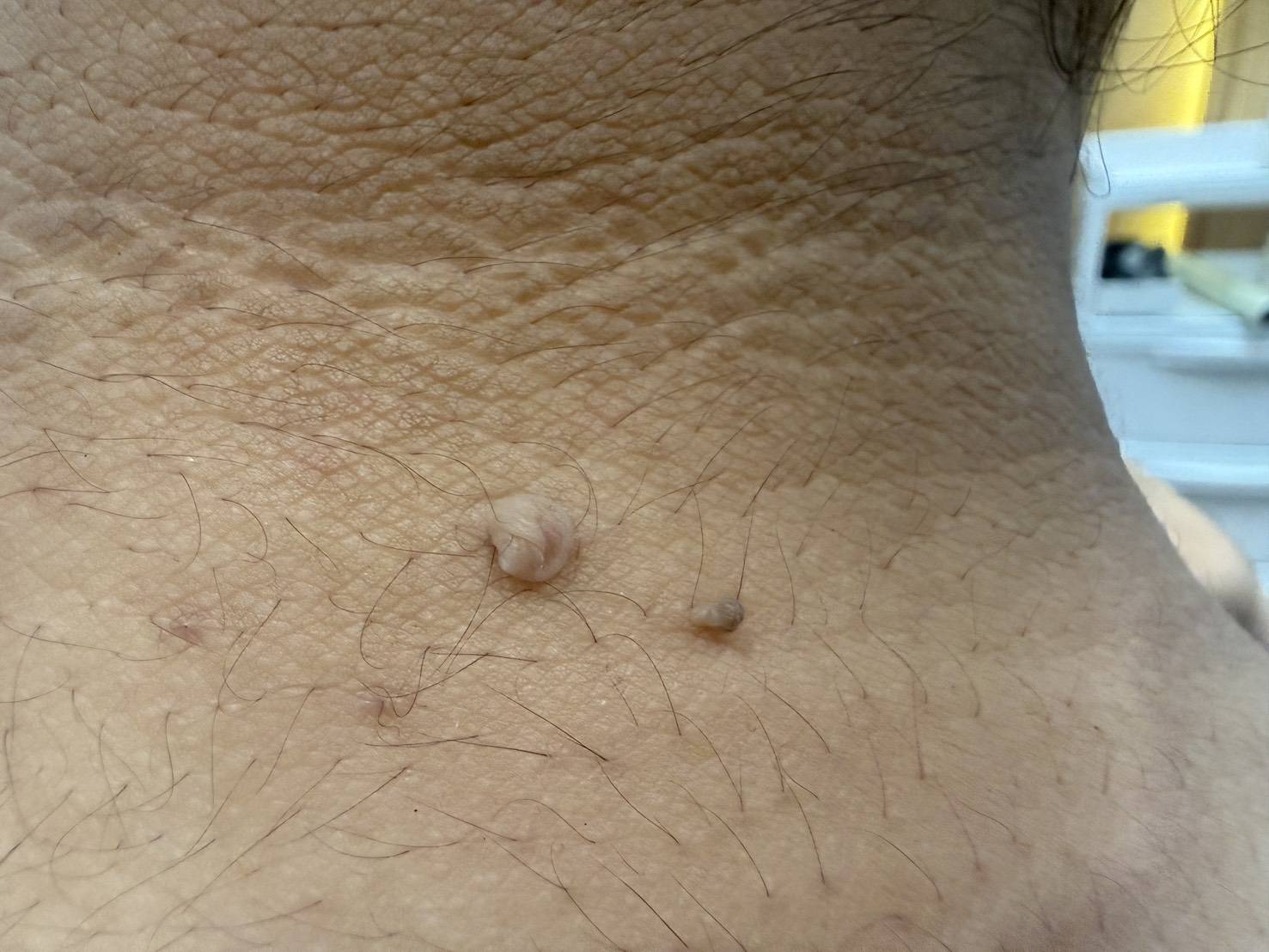 Skin tag before CO2 laser removal at BAC Clinic Bangkok