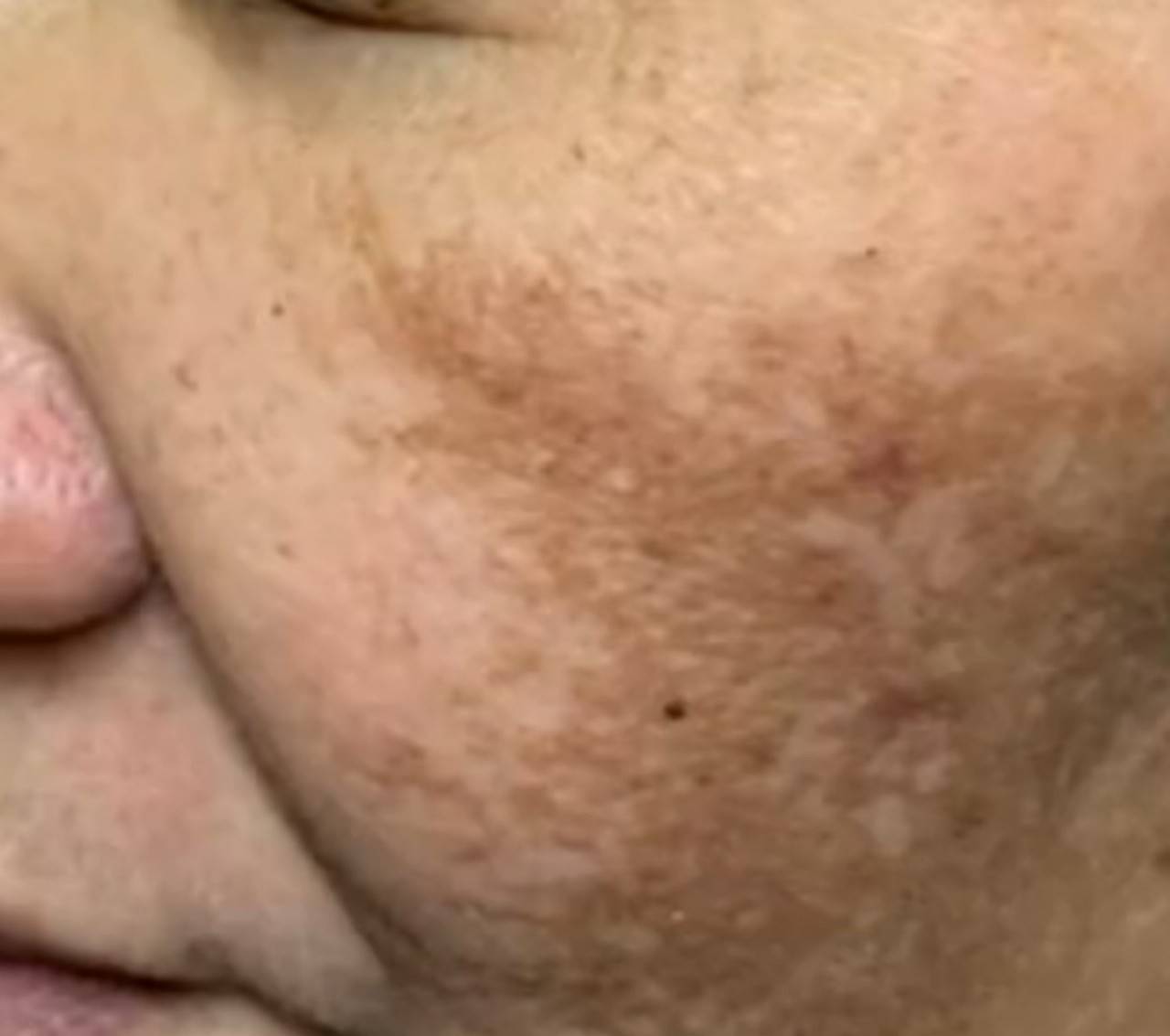 Before treatment with Pico Melasma Klear and Bio-Revitalize Mesotherapy