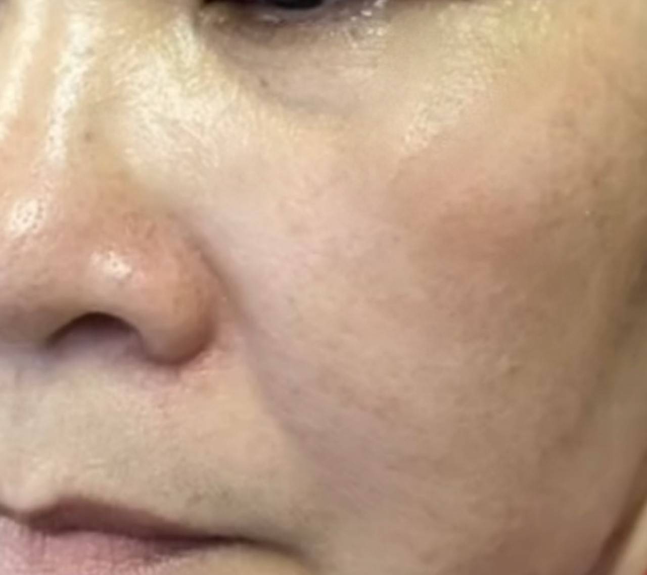 After treatment with Pico Melasma Klear and Bio-Revitalize Mesotherapy