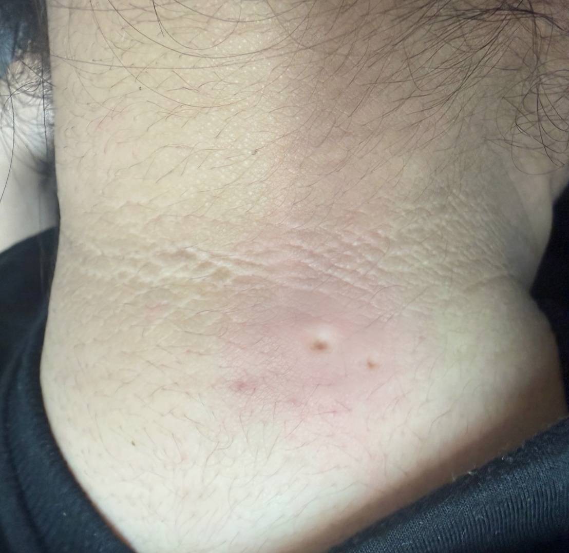 Immediately after CO2 laser skin tag removal at BAC Clinic Bangkok
