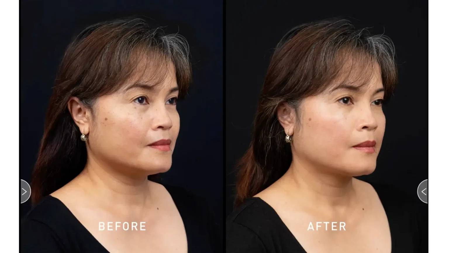 NCTF 135 HA Program Chanel Injection at BAC Bangkok Aesthetic Clinic