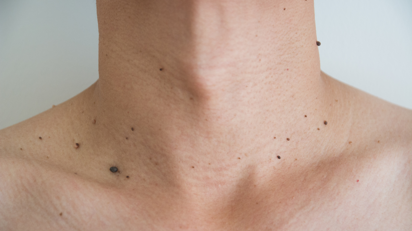 UltraPulse CO2 Laser Bangkok for mole and skin tag removal at BAC Clinic