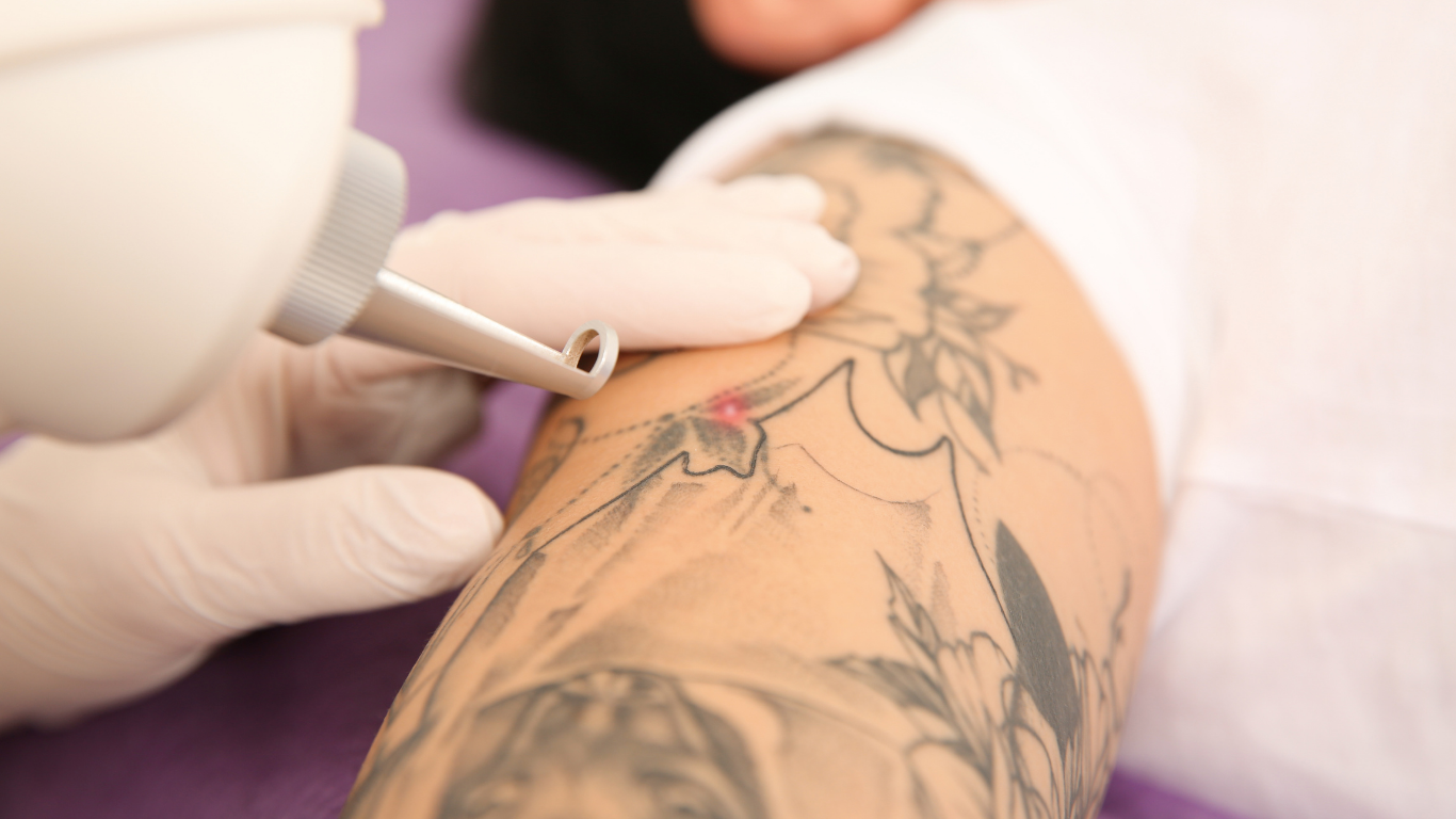 Picosecond Laser tattoo removal using 532, 755 and 1064 nm wavelengths at BAC Clinic Bangkok
