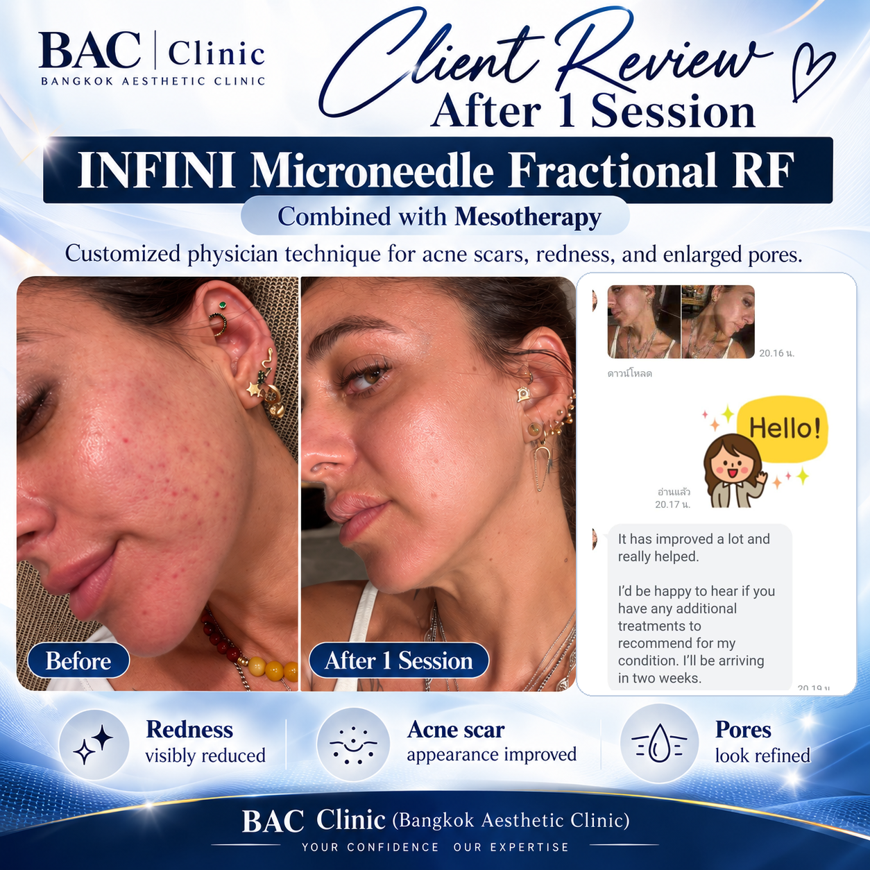 BAC Clinic client review after 1 session of INFINI Microneedle Fractional RF combined with mesotherapy for acne scars redness and enlarged pores