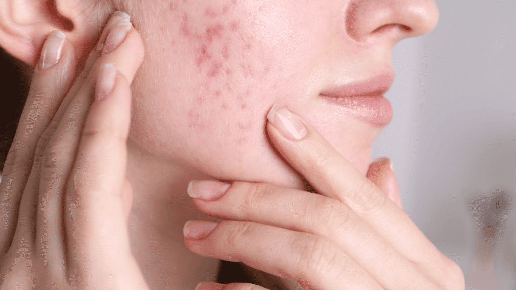 Educational medical illustration demonstrating how subcision can release fibrous bands beneath depressed rolling acne scars. The image accompanies BAC Clinic Bangkok's guide to acne scar revision, including blunt cannula and Nokor techniques, multilayer subcision, INFINI RF Microneedling combinations, recovery, safety, and treatment pricing. Illustration is for educational purposes and does not represent a guaranteed treatment outcome.
