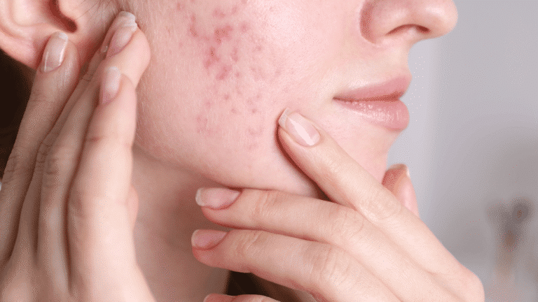 Educational medical illustration demonstrating how subcision can release fibrous bands beneath depressed rolling acne scars. The image accompanies BAC Clinic Bangkok's guide to acne scar revision, including blunt cannula and Nokor techniques, multilayer subcision, INFINI RF Microneedling combinations, recovery, safety, and treatment pricing. Illustration is for educational purposes and does not represent a guaranteed treatment outcome.